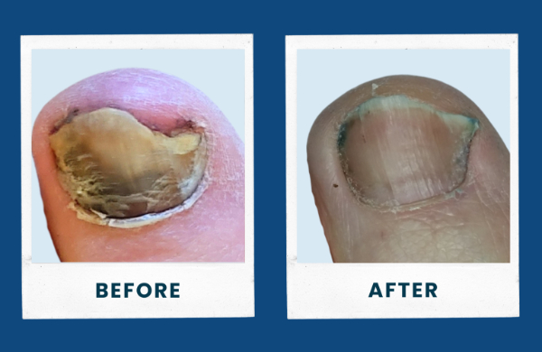 ToeFX Light Therapy before and after